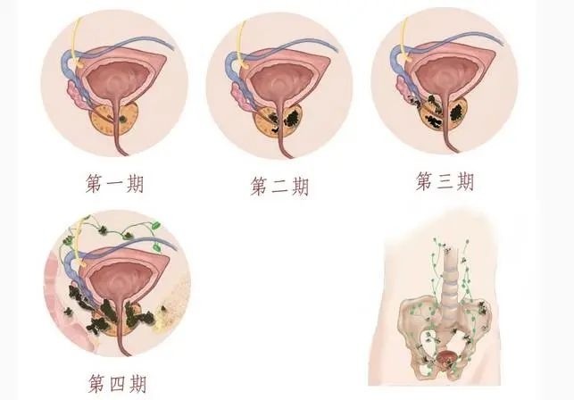 济南哪个医院治肿瘤好-前列腺癌有哪些预防建议？