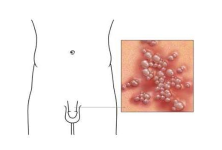 康复指南：太原治疗性病有效的医院-生殖器疱疹溃疡会持续增加吗
